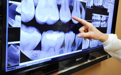 What Are Digital Dental X-Rays?