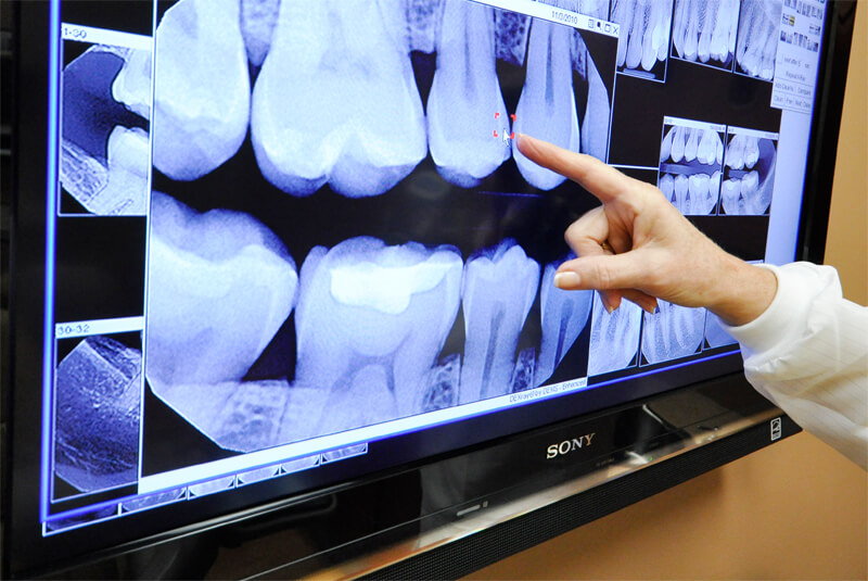 What Are Digital Dental X-Rays?