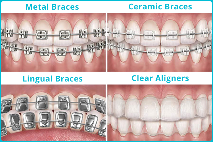 Things to Know Before Getting Braces In Singapore ...