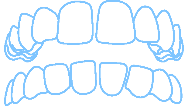 Invisalign solves gaps in teeth and spacing between teeth