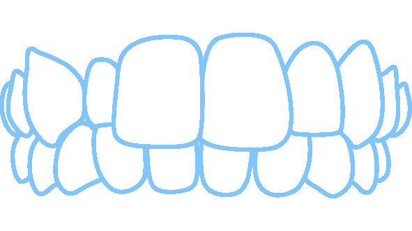 Invisalign fixes cross bites