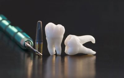 What are Dental Implants? Am I A Suitable Candidate?