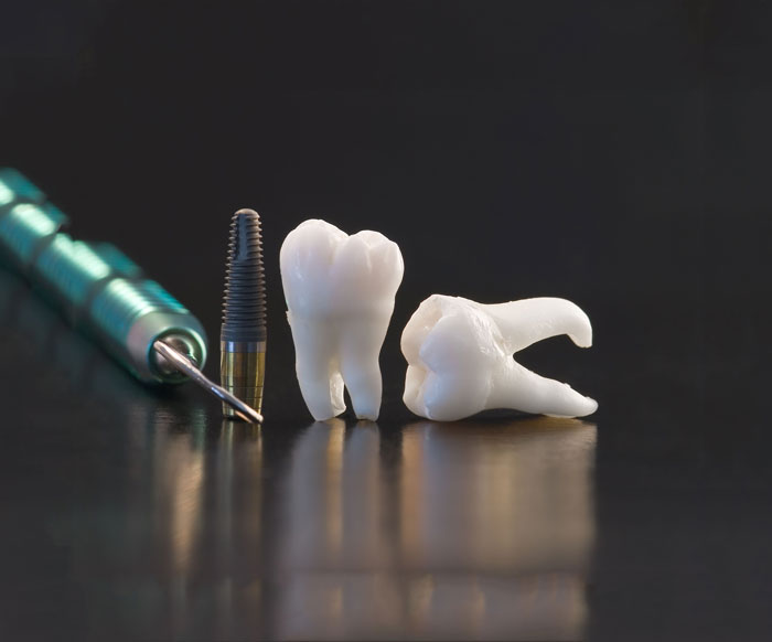 What are Dental Implants? Am I A Suitable Candidate?
