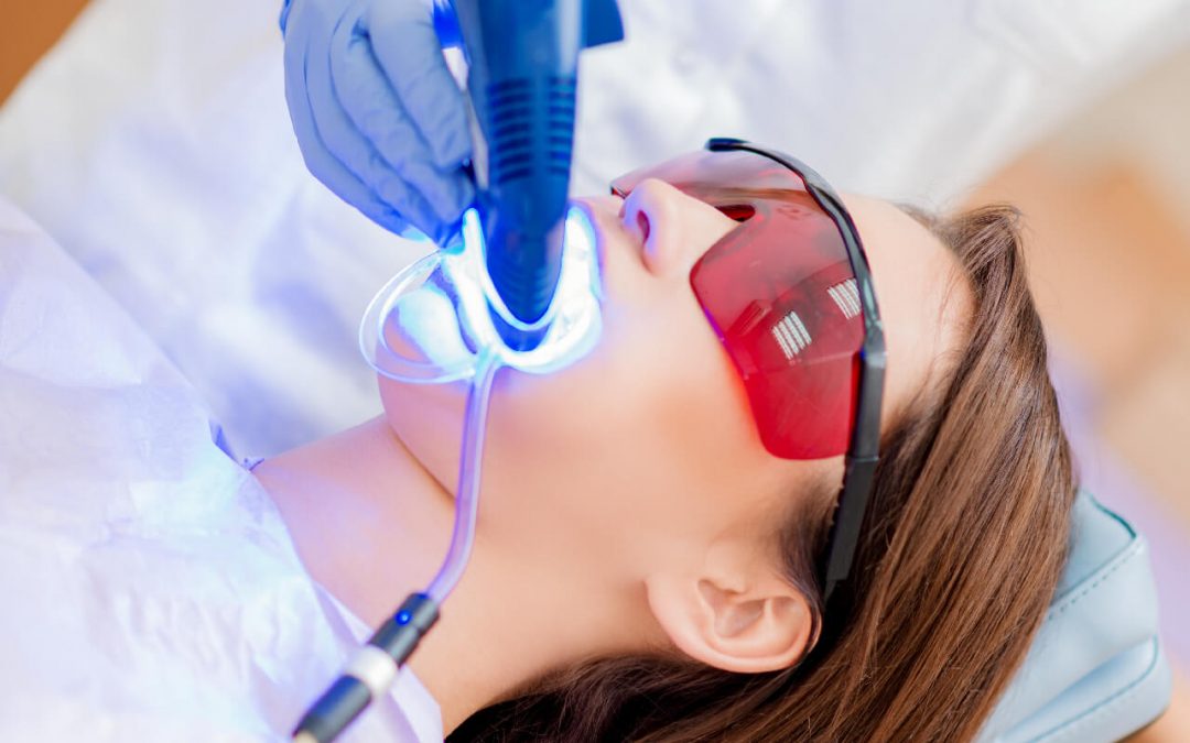 Laser Teeth Whitening Explained