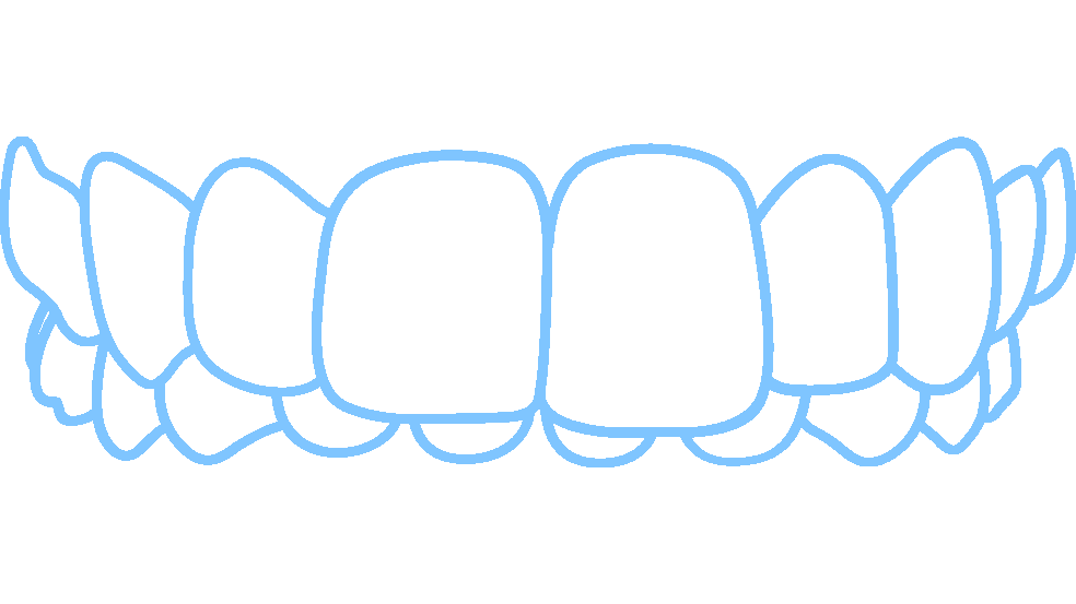 Invisalign fixes over bites 