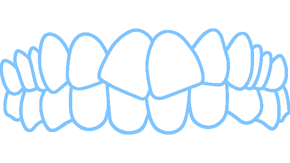 Invisalign fixes crowded teeth