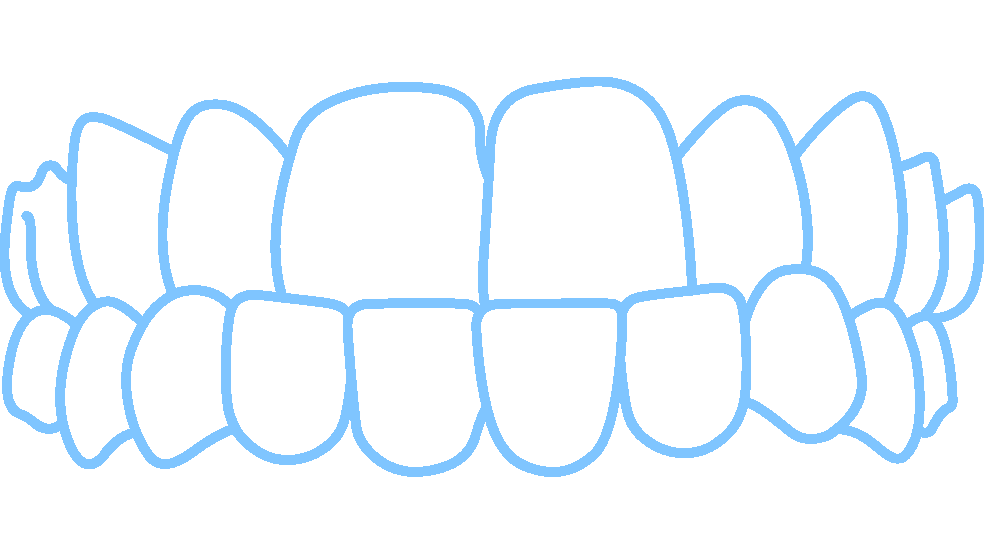 Invisalign fixes under bites